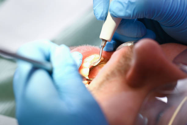 Best Broken Tooth Emergency  in Berry Creek, CA