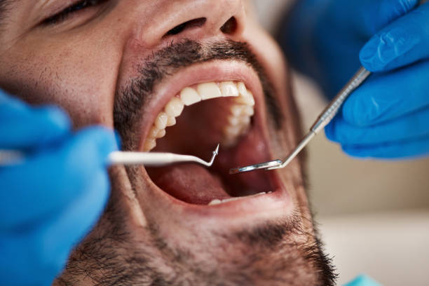 Best Emergency Gum Pain Relief  in Berry Creek, CA